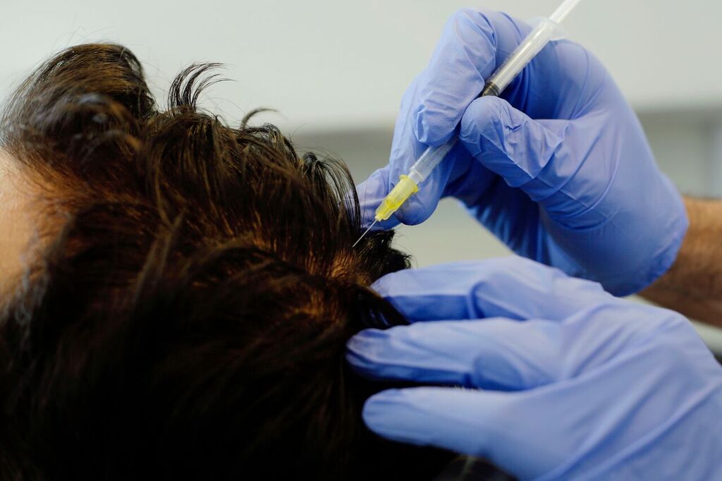 Hair Loss Treatment: it time for PRP? - Barber Surgeons Guild®