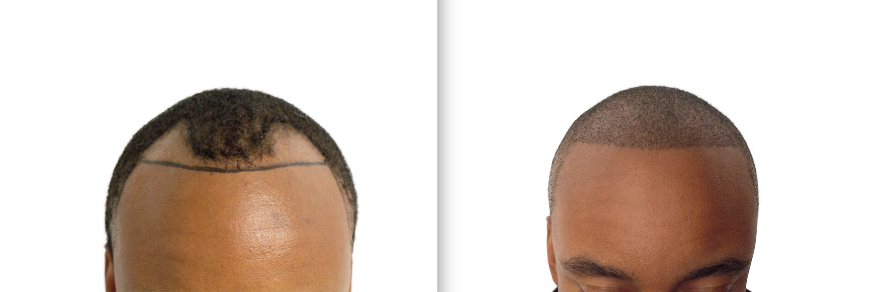 These Signs of Balding Can Be Reversed - Barber Surgeons Guild®