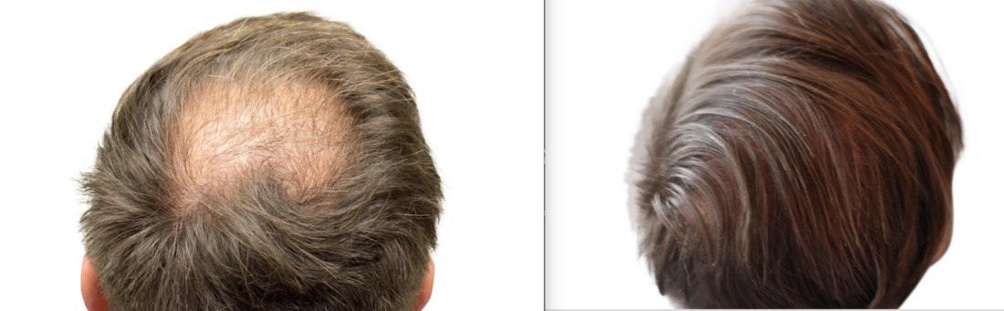 hairline restoration
