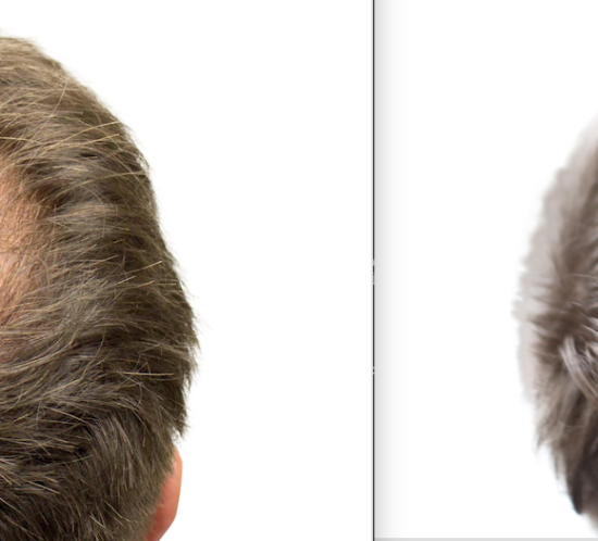 hairline restoration