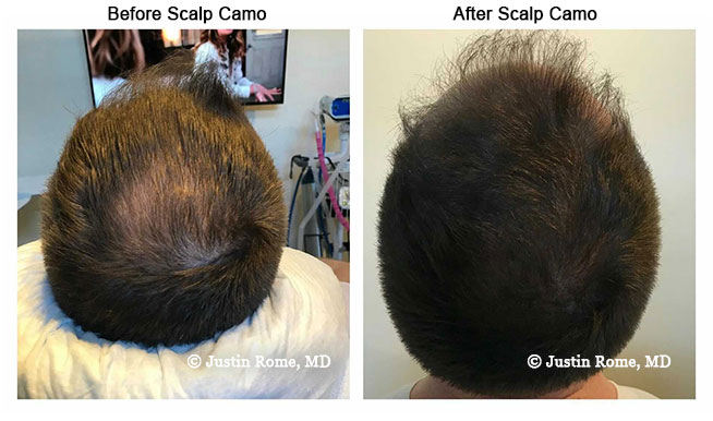 Scalp Camo Before & After