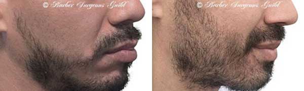 Beard Restoration Before & After