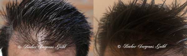 Scalp Camo Before & After
