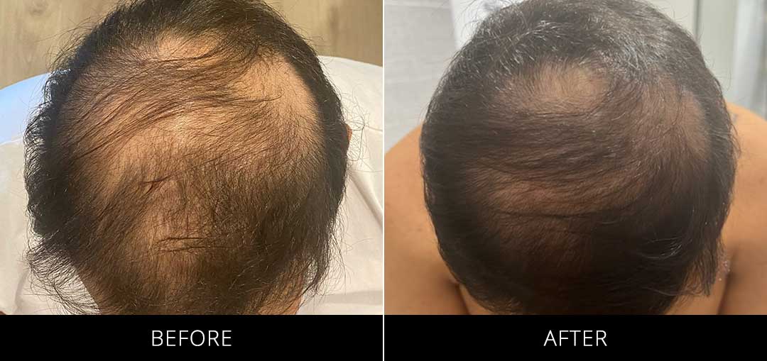 PRP Before & After