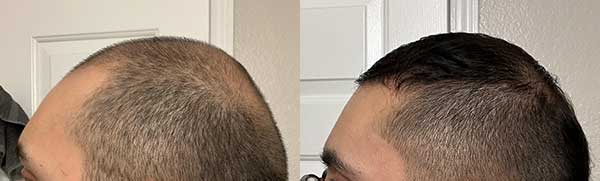 Before & After Combined Treatment