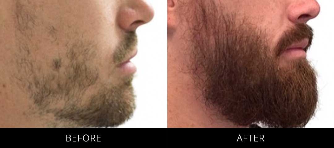 Beard Restoration Before & After