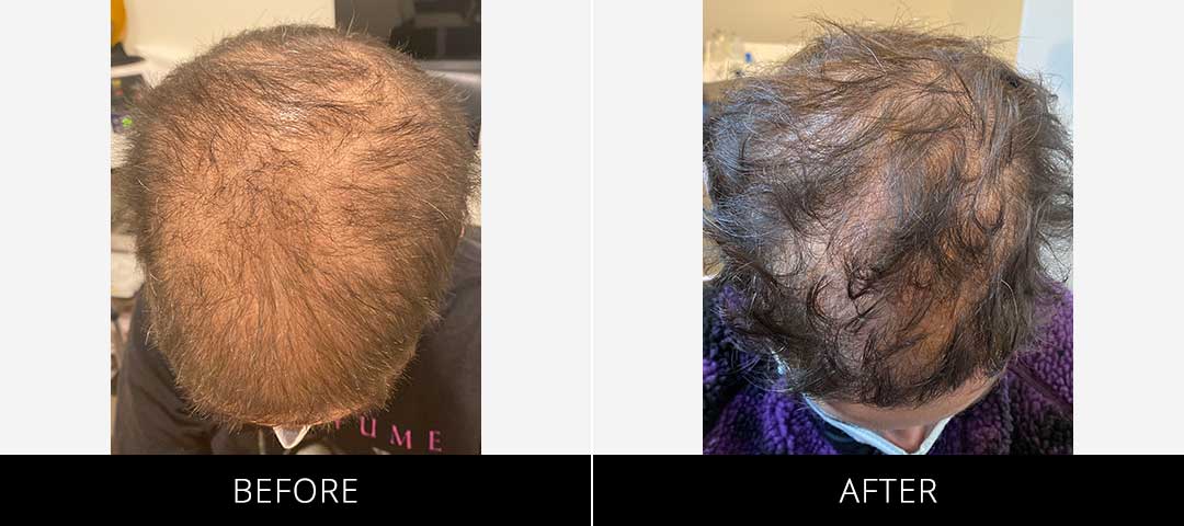 PRP Before & After Crown