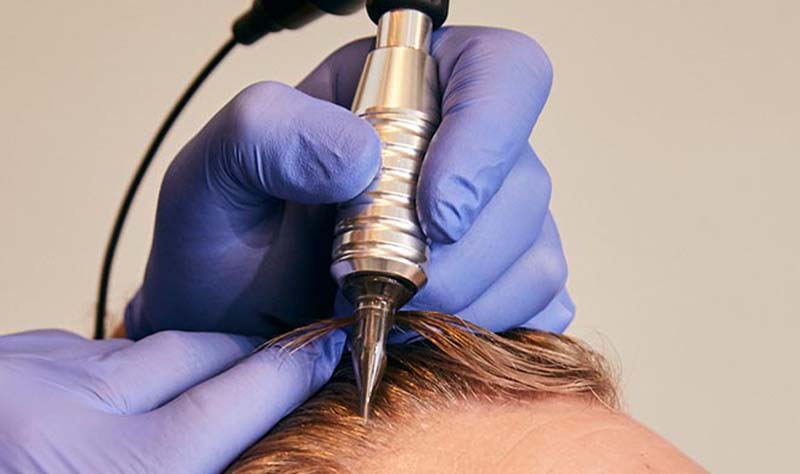 Scalp micropigmentation tattoos fill in bald spots