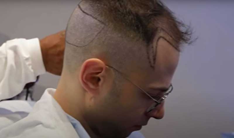 The Try Guys: Watch Zach get robotic hair restoration surgery at BSG