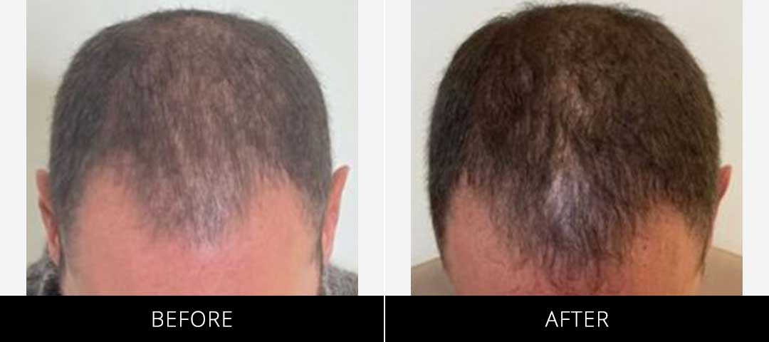 CryoStim Before and After