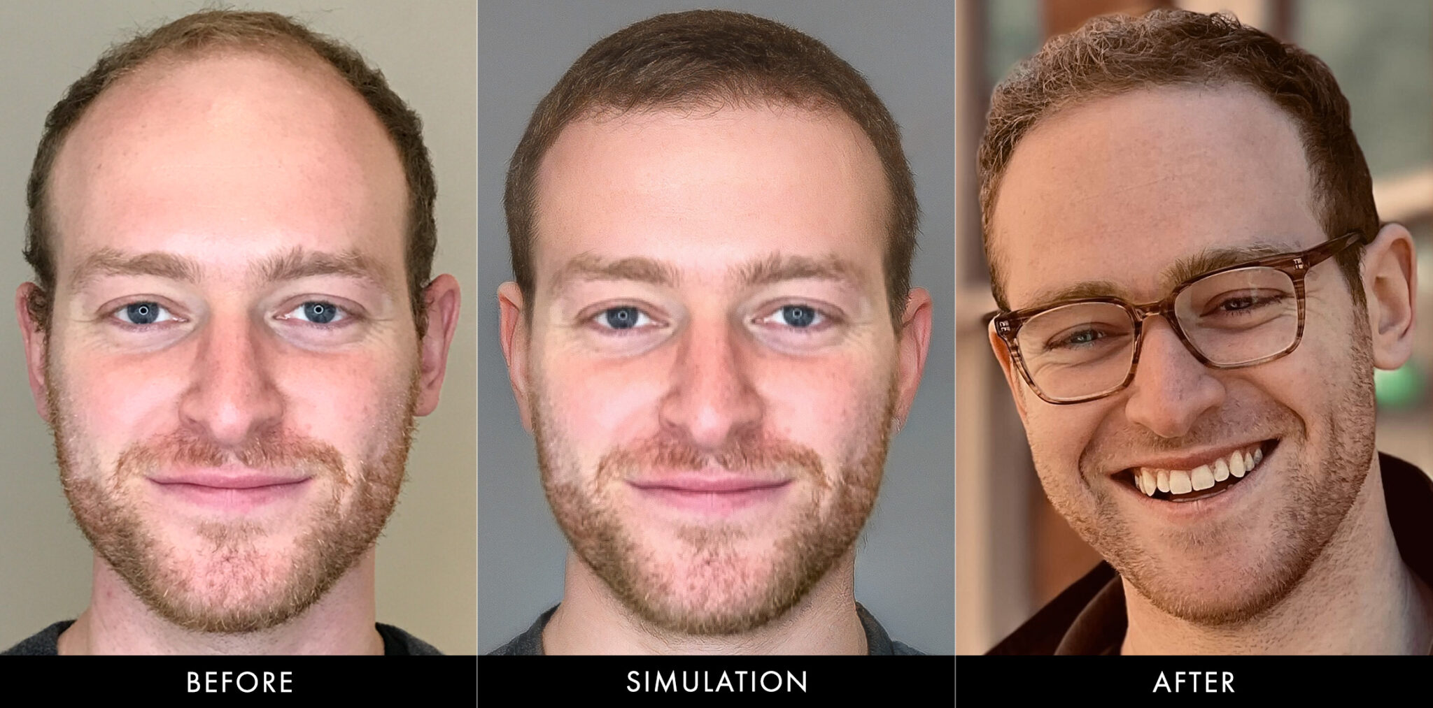 Hair Restoration Before & After Simulation