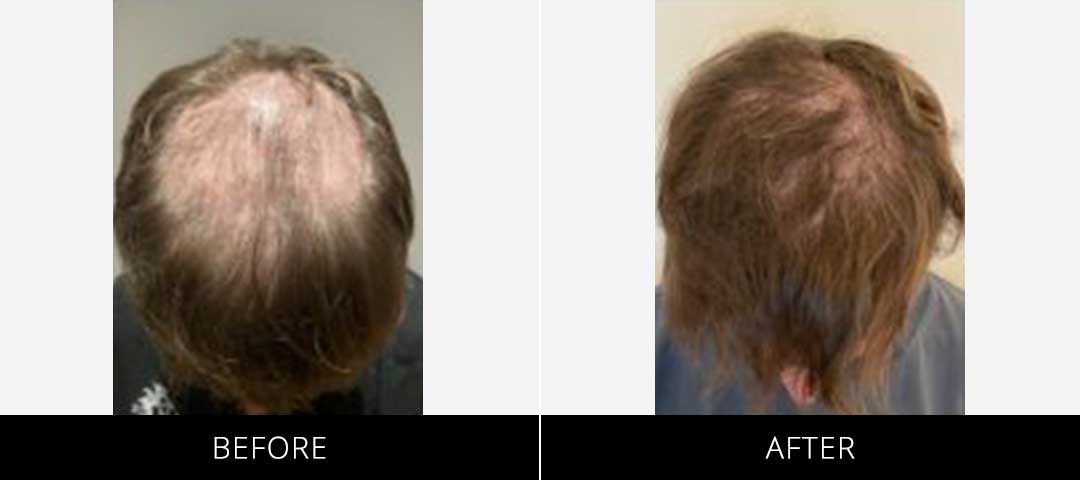 barbersurgeonsguild-cryostim-beforeafter-15