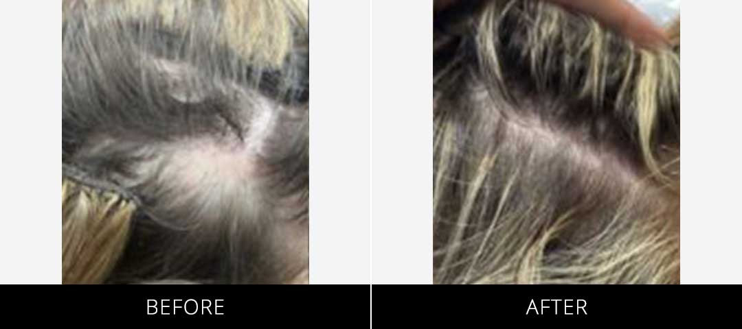 barbersurgeonsguild-cryostim-beforeafter-16