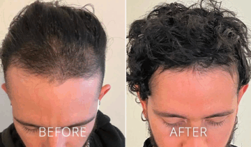 cryoprp-before-and-after cryoprp-before-and-after