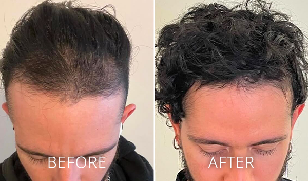 cryoprp-before-and-after