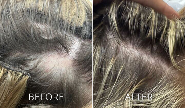 cryoprp-before-and-after