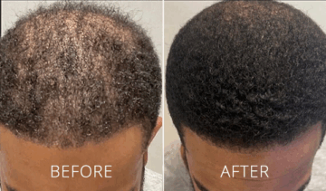 exosomes-before-and-after exosomes-before-and-after