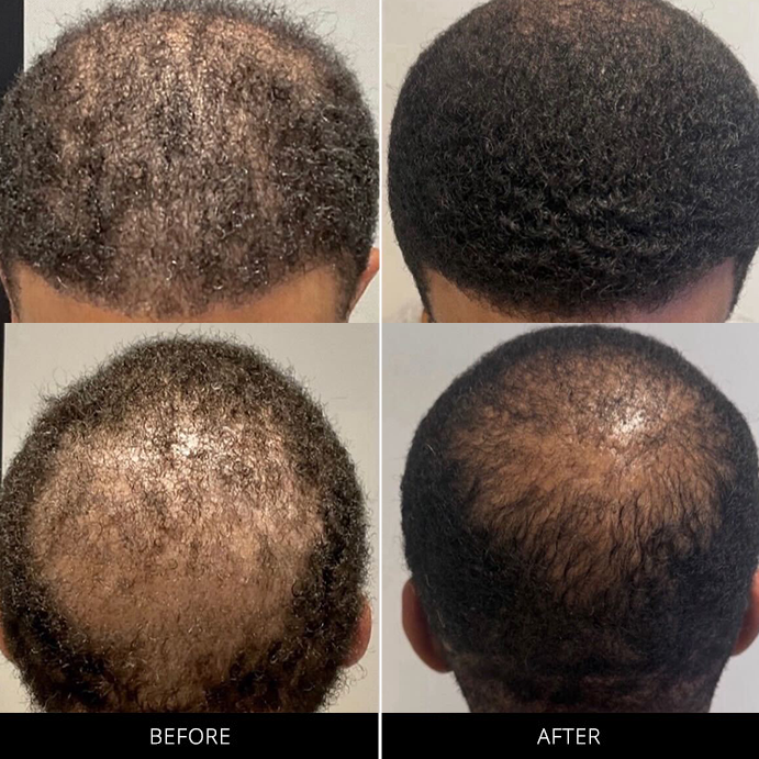 cryostim-before-after-03-4x4-1