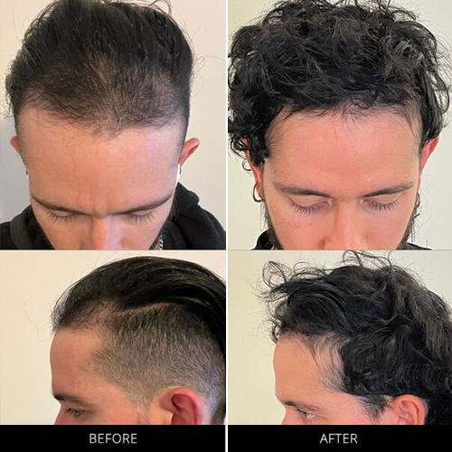 CryoStim Before & After