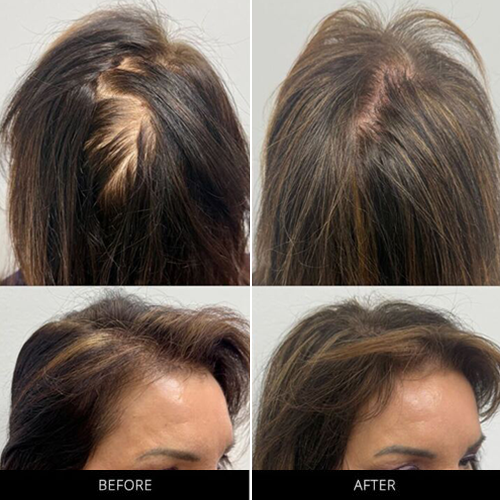 CryoStim Before & After