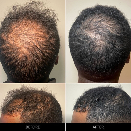 CryoStim Before & After