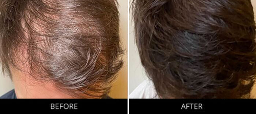 CryoStim Before & After