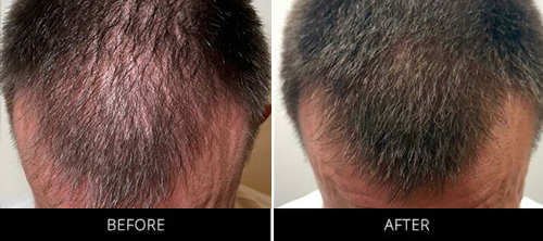 CryoStim Before & After