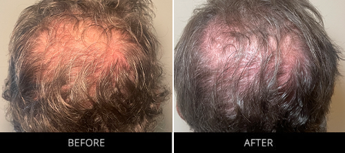 CryoStim Before & After