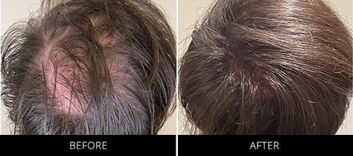 CryoStim Before & After