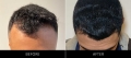 Hair Restoration Before & After Top