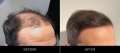 Hair Restoration Before & After Right