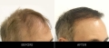 Hair Restoration Before & After Right