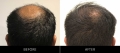 Hair Restoration Before & After Crown