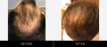Hair Restoration Before & After Crown