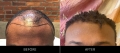 Hair Restoration Before & After Front