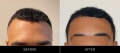 barbersurgeonsguilHair Restoration Before & After Front