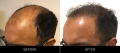 Hair Restoration Before & After Left