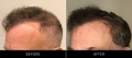 Hair Restoration Before & After Left