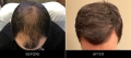 Hair Restoration Before & After Top