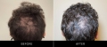 Exosomes Before & After Crown